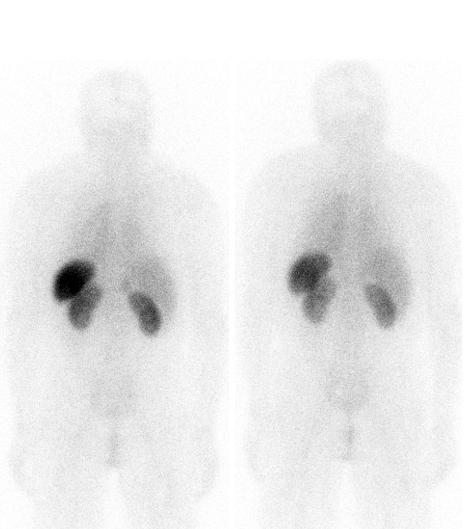 Combination Treatment for Rare Disease Safely Clears Protein Deposits in Vital Organs (2 of 2)