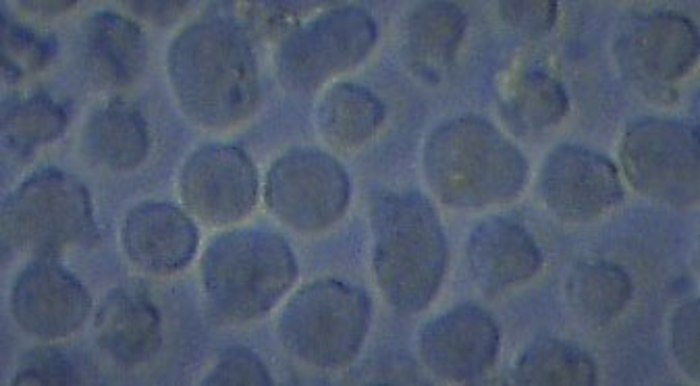 Cells of a type B acute leukemia, a disease against which treatment with CAR-T cells has demonstrated to be effective.