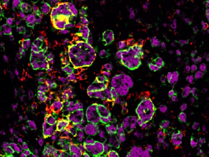 Macrophages attacking adrenal tumour in male mouse.