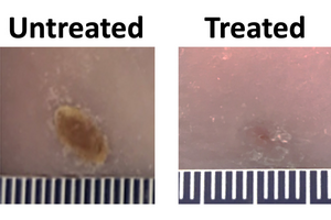 Wound dressing