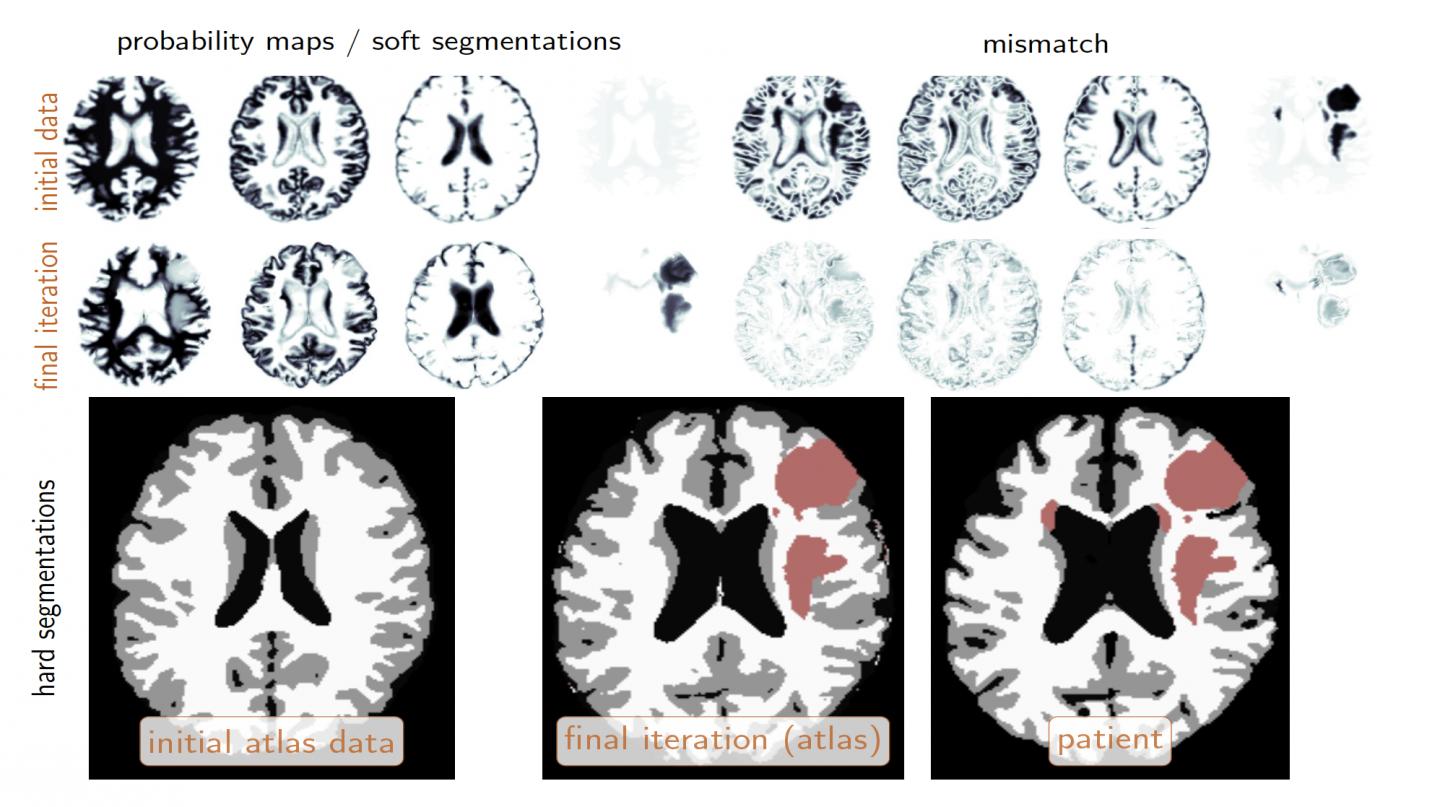 Brain Image Segmentation and Analysis