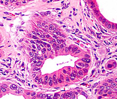 Invasive Stage Lesion from the Human PDAC-iPS Line