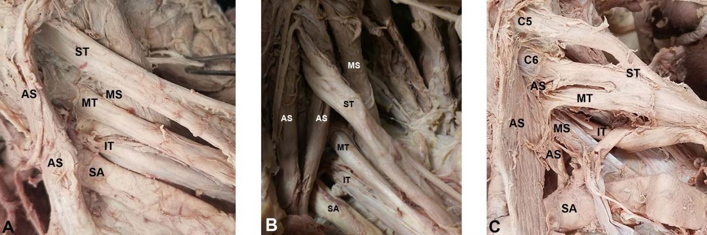 brachial plexus cadaver labeled