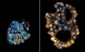 Normal liver organoid and liver tumor organoid