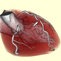 3D Representation of the Heart