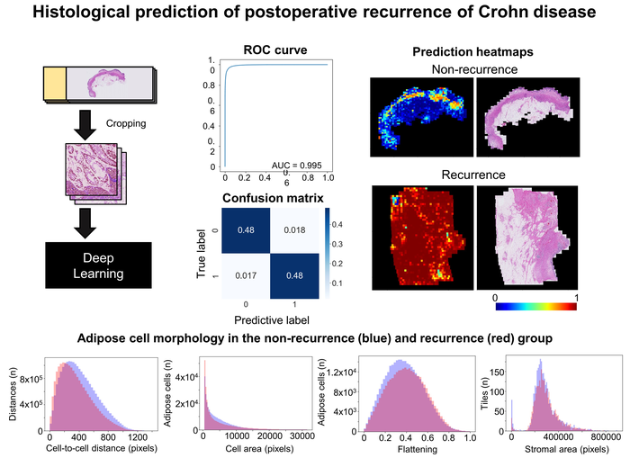 Artificial intelligence model can predict whether Crohn's disease will recur after surgery