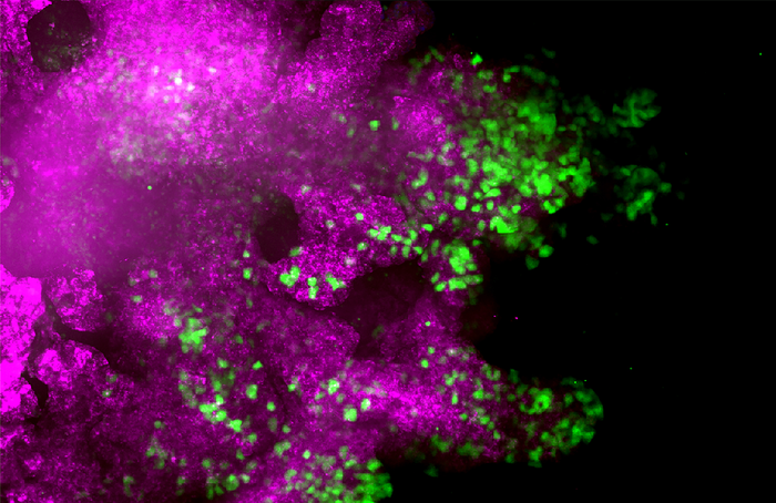 Breast cancer metastasis