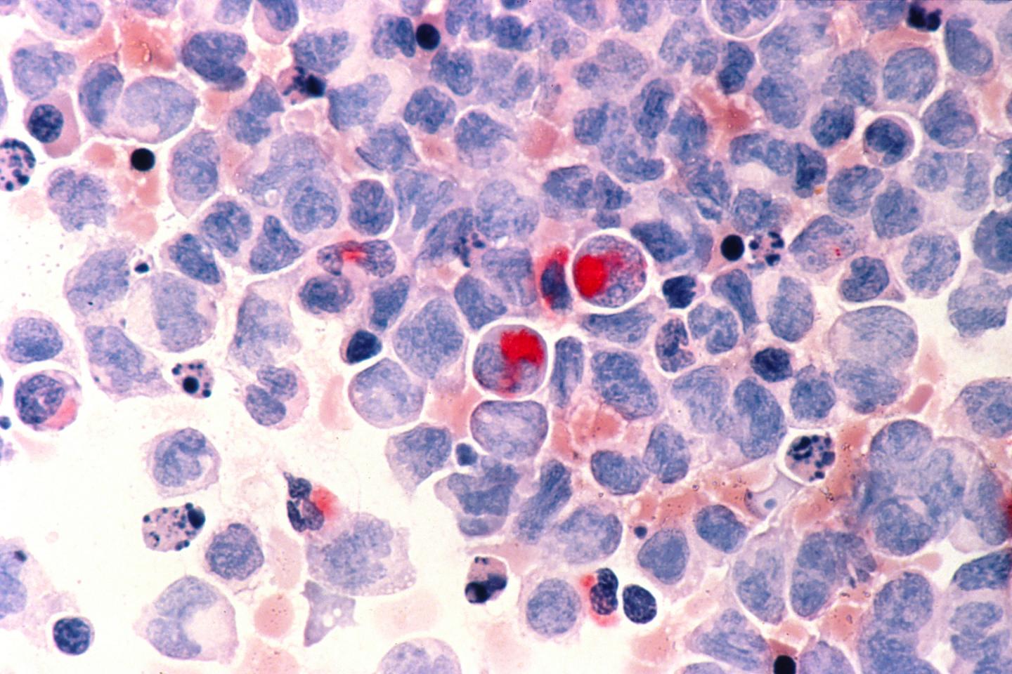 Acute Myeloid Leukemia