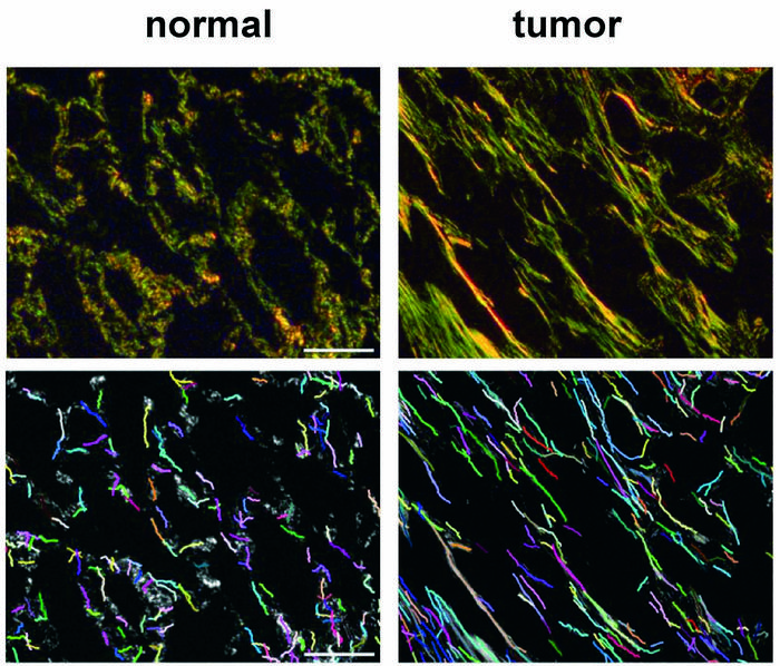 Researchers identify new biomarkers of the most frequent lung cancer