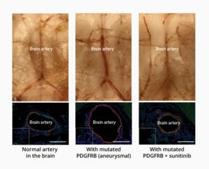 First drug treatment for aneurysm in a mouse model