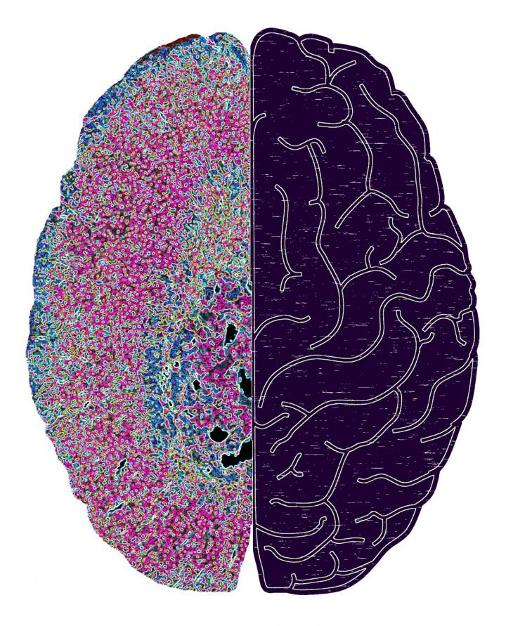 Study: Strategy Might Prevent Infections in Patients with Spinal Cord Injuries