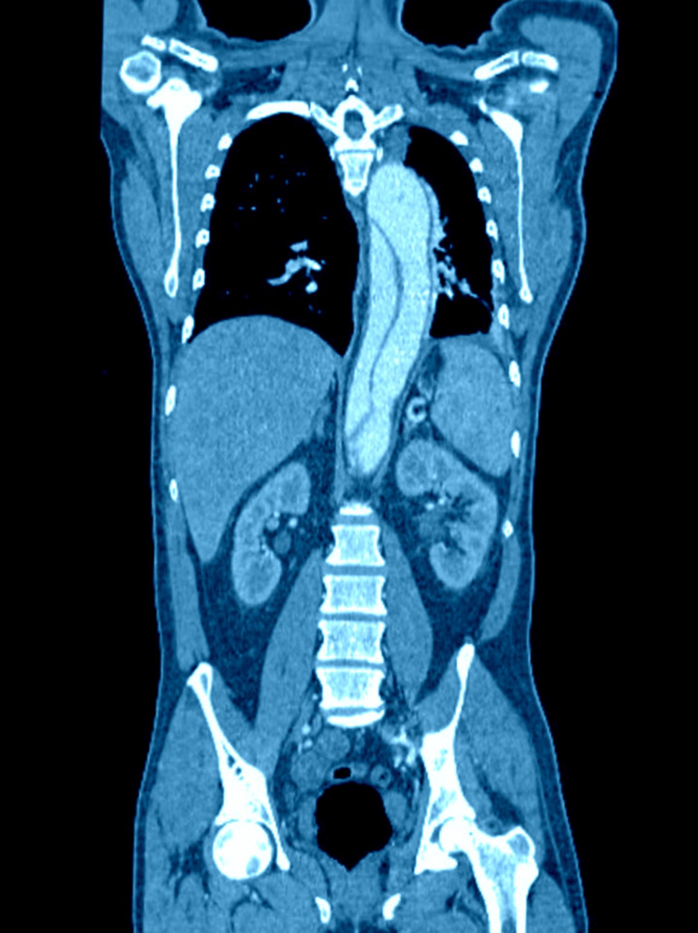 IV Contrast Not Associated Wit IMAGE EurekAlert Science News Releases