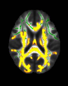 MRI Shows Increased Neuroinflammation Associated with Higher Hidden Fat