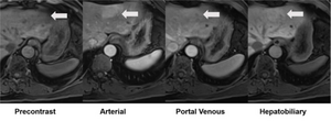 54-year-old with pathologically confirmed inflammatory adenoma in left lobe that underwent evaluation by gadoxetate disodium-enhanced MRI