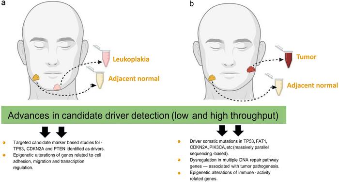 Progression of Oral Leukoplakia to Cancer