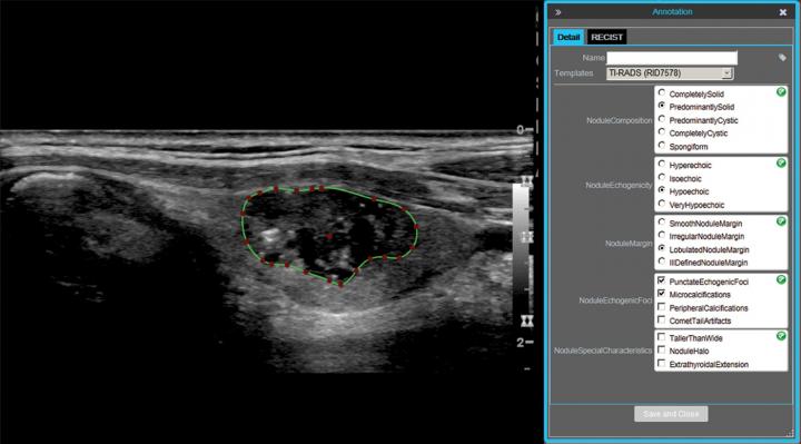 thyroid cancer ultrasound