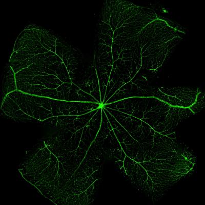 Ubretinal Hemorrhage in a Wet Macular Degeneration Patient