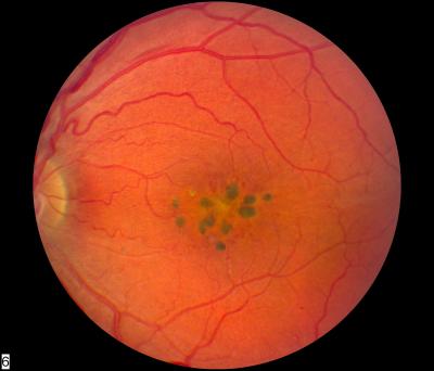 Affected Macula of a Person with a Newly Identified Rare, Inherited Retinal Disease
