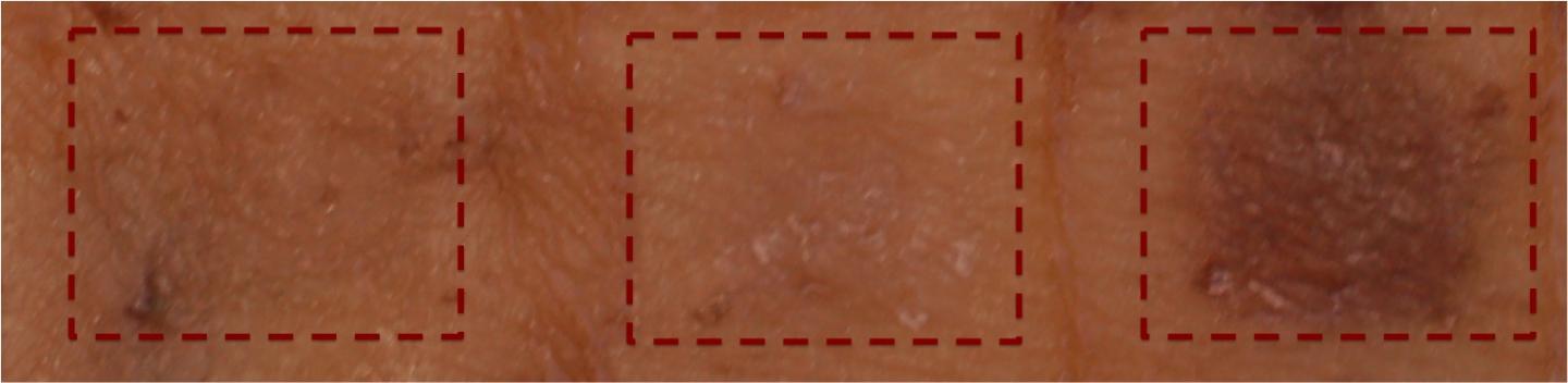Human Skin Explants Treated with Pigment Inducer