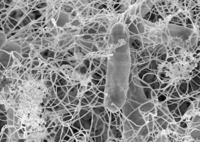 Study  Offers Clues As To Why Some Patients Get Infections From Cardiac Implants