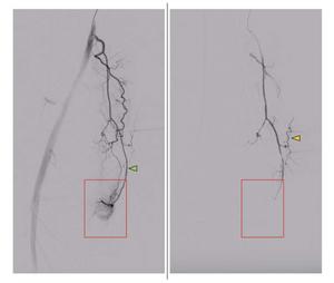 Peri-interventional DSA of the descending genicular artery (DSA)