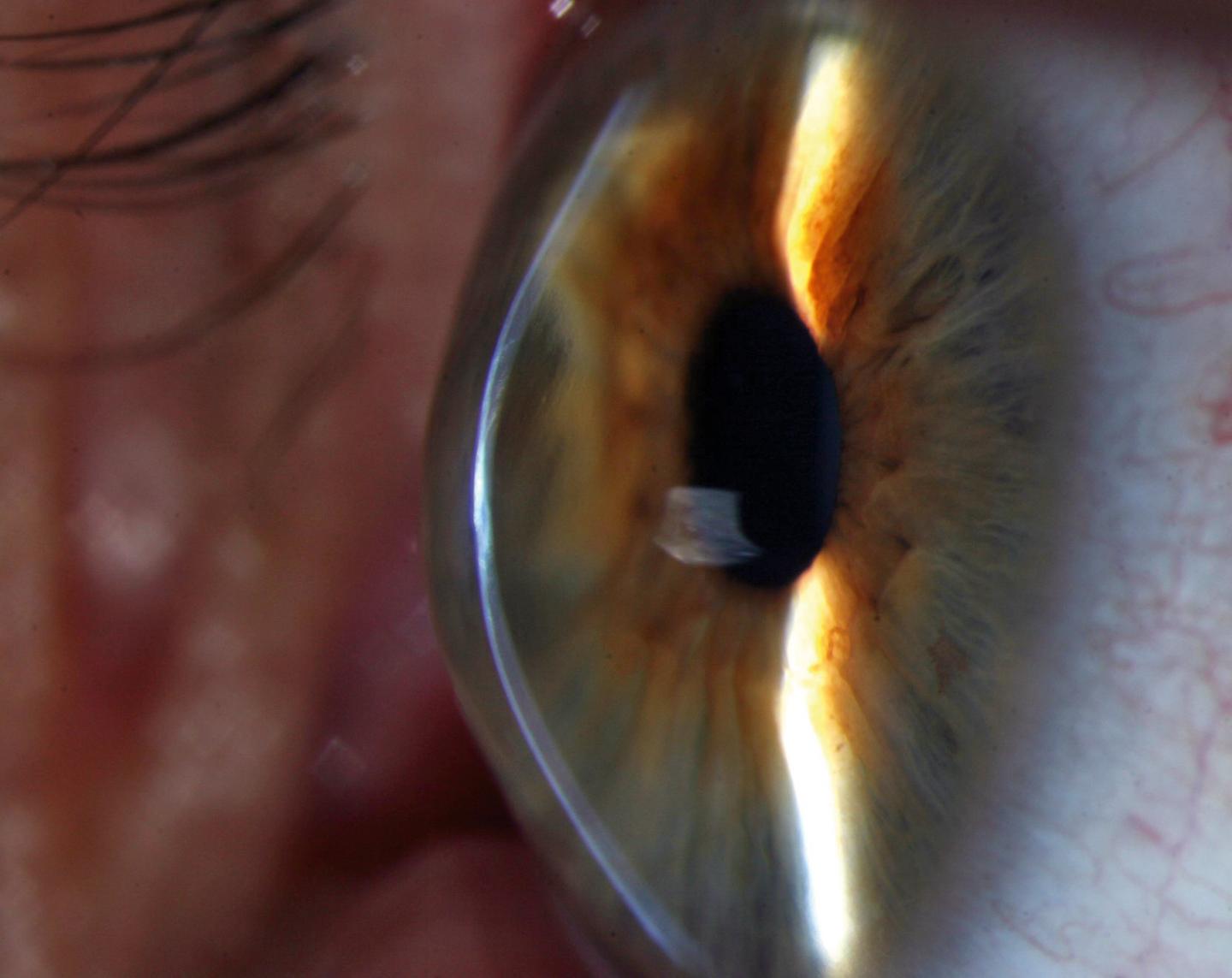 The cornea of a keratoconus patient