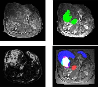 MRI for Prostate Cancer ID
