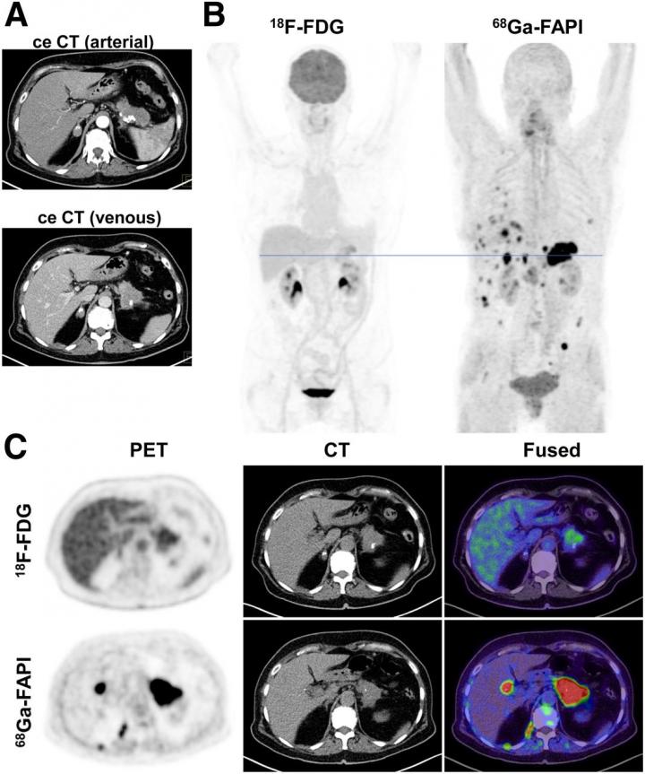 Primary staging of a patient with pancreatic ductal adenocarcinoma.