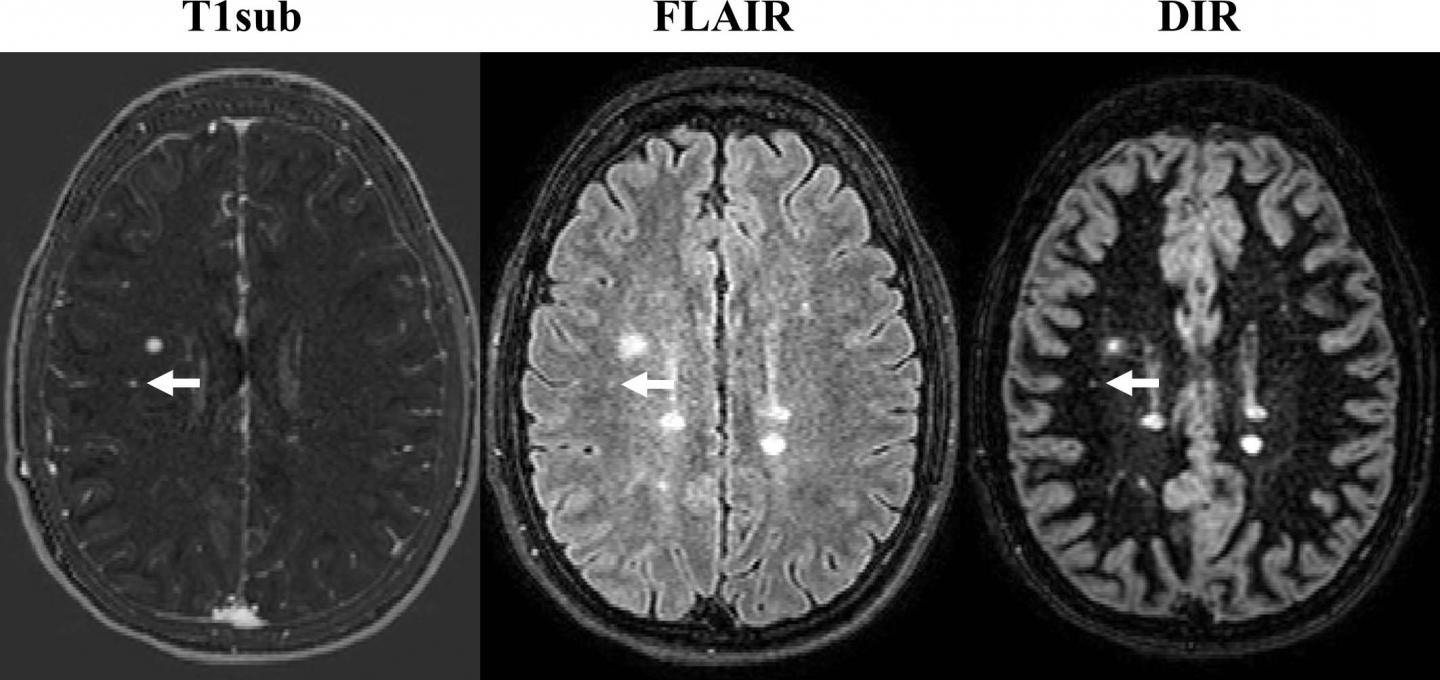 Axial MR Images in 24-year-old Woman with Relapsing-Remitting Multiple Sclerosis