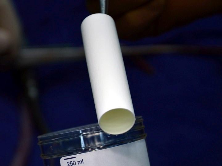 First Clinical Use of Bioabsorbable Vascular Grafts in Children Shows Promise