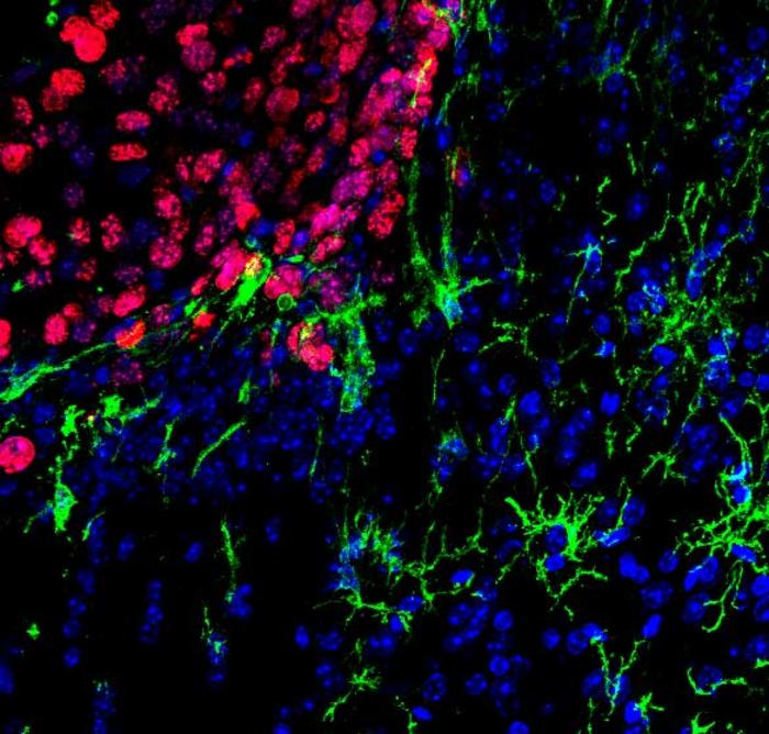 The image shows microglial cells (in green) infiltrating tumor cells in a melanoma metastasis (in red). The cell nuclei are stained blue