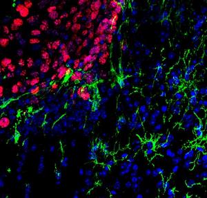 The image shows microglial cells (in green) infiltrating tumor cells in a melanoma metastasis (in red). The cell nuclei are stained blue