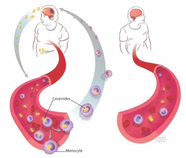 BMI Affects Course of Multiple Sclerosis