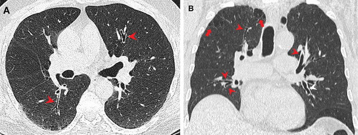 pot smokers lungs vs healthy lungs