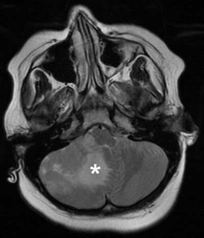 Brain Scan Image of Brain Tumor