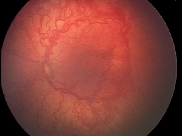 Severe Retinopathy of Prematurity