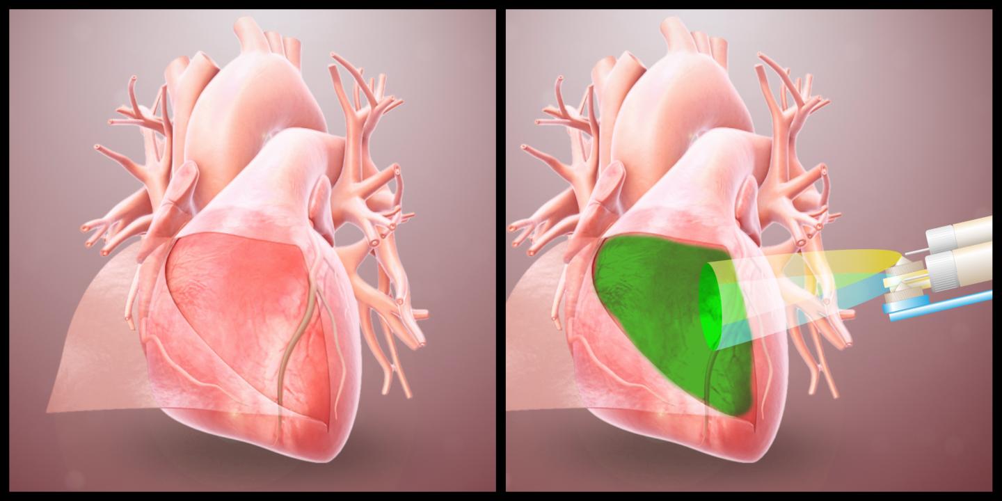 Device spraying hydrogel on the heart (illustration)