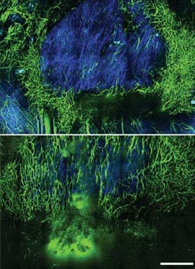 Treatment with Losartan