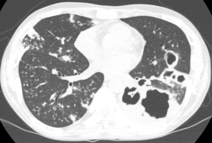 Lung Damage Caused by TB infection