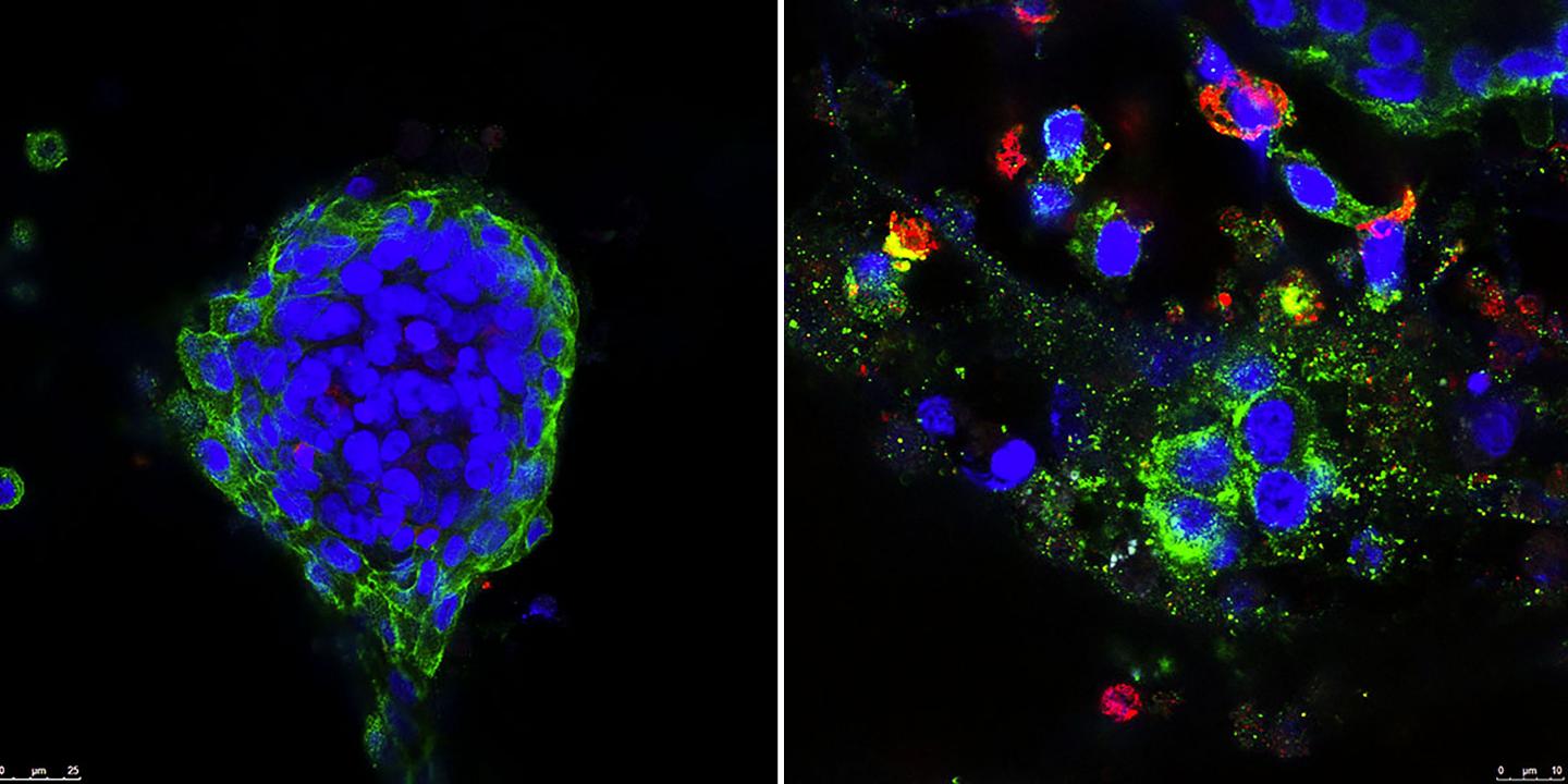 Combination Treatment Destroys Patient Tumor Tissue