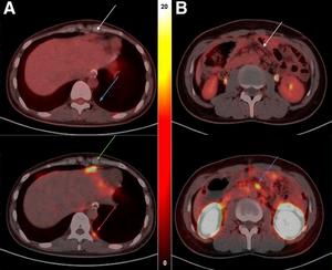 PET/CT Imaging of CLDN18.2 Expression