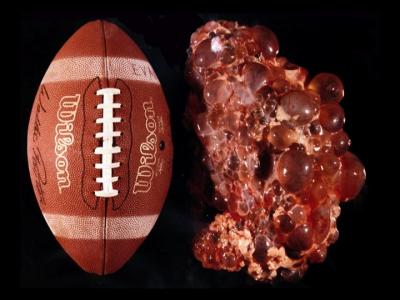 Polycystic Kidney