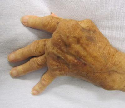 Rheumatoid Arthritis