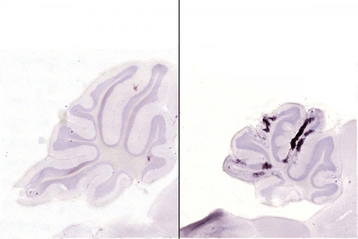 French Polynesian and Paraíba Zika infection