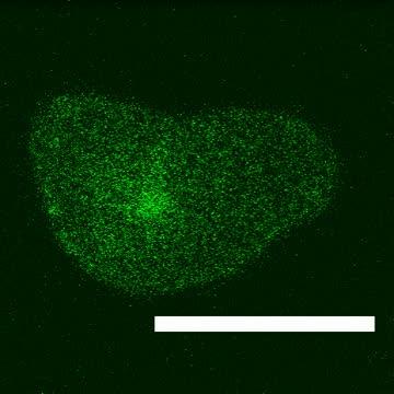 Mutation Links Malignant Hyperthermia to Bleeding Disorder (1 of 2)