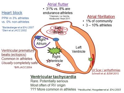 High Levels of Intense Exercise May Be Unhealthy for the Heart