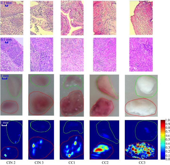 Comparison between the Normal Cervical Tissue and Tissue Lesion for Different Stages
