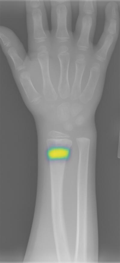 A Heatmap Overlaid on the Radiograph