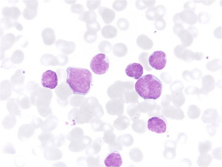 Leukemia