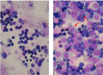 Aggressive Leukemia Hijack Normal Protein to Grow